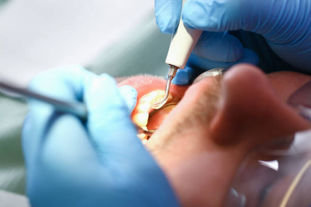 Best Emergency Root Canal Therapy in Beechwood, MI