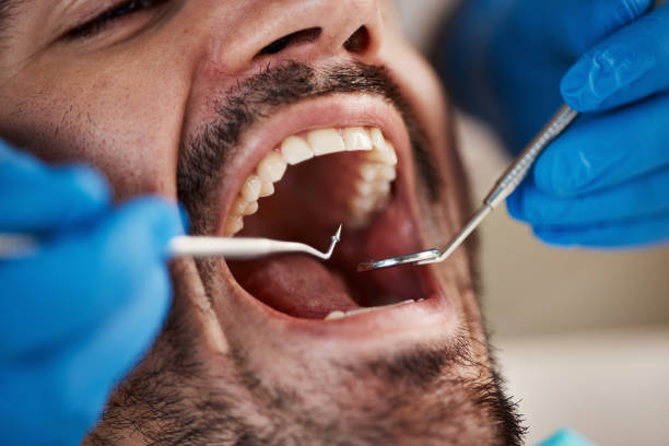 Best Dental Abscess Treatment in Beechwood, MI